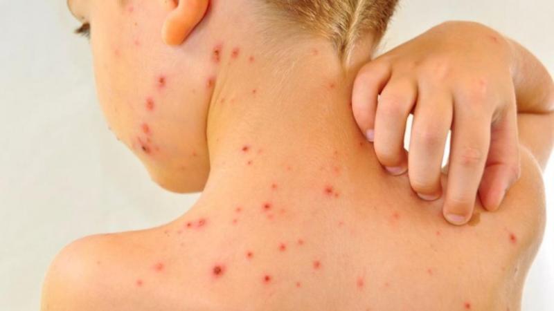 Alerta: aumenta a 1,755 los casos de varicela en lo que va del año ...