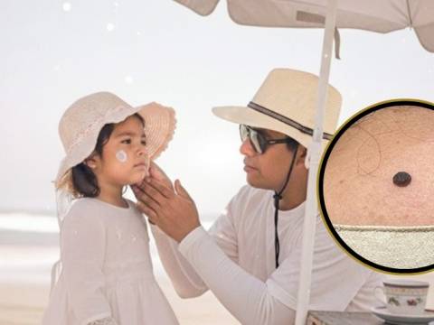 Minsa piel radiación solar