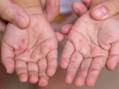 Virus Coxsackie